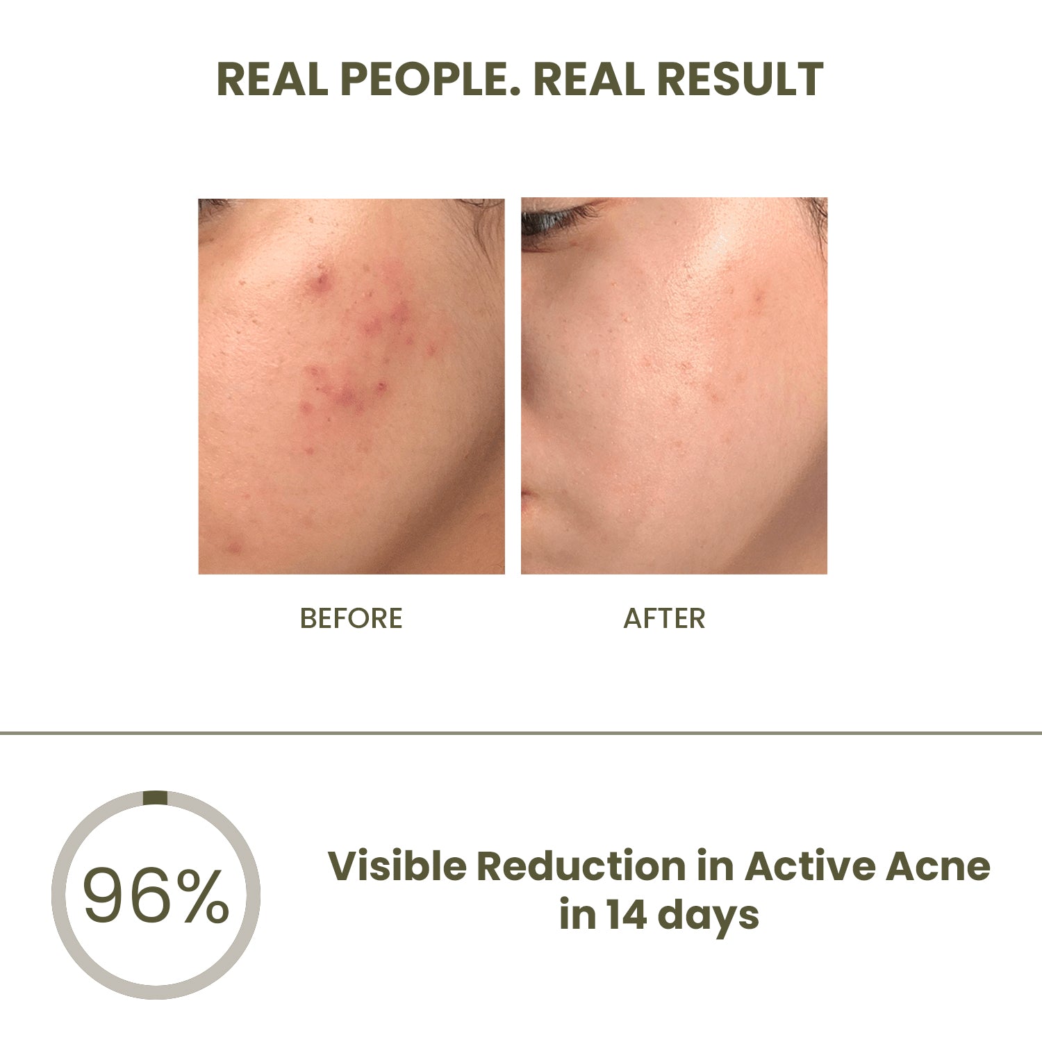 Anti-Acne & Pimple Set