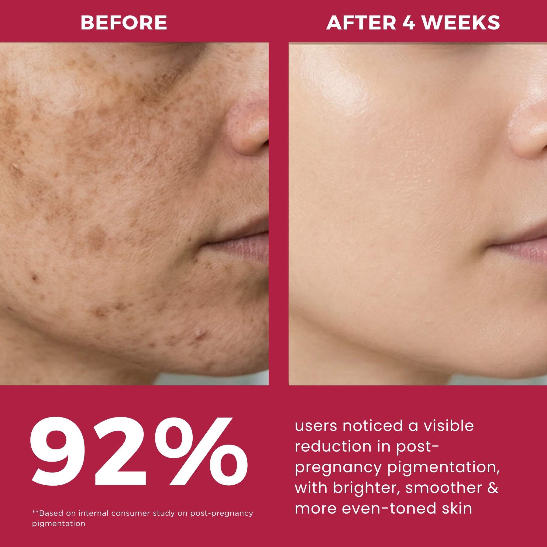 Post Pregnancy 3 steps-Facewash+Serum+Moisturising Cream