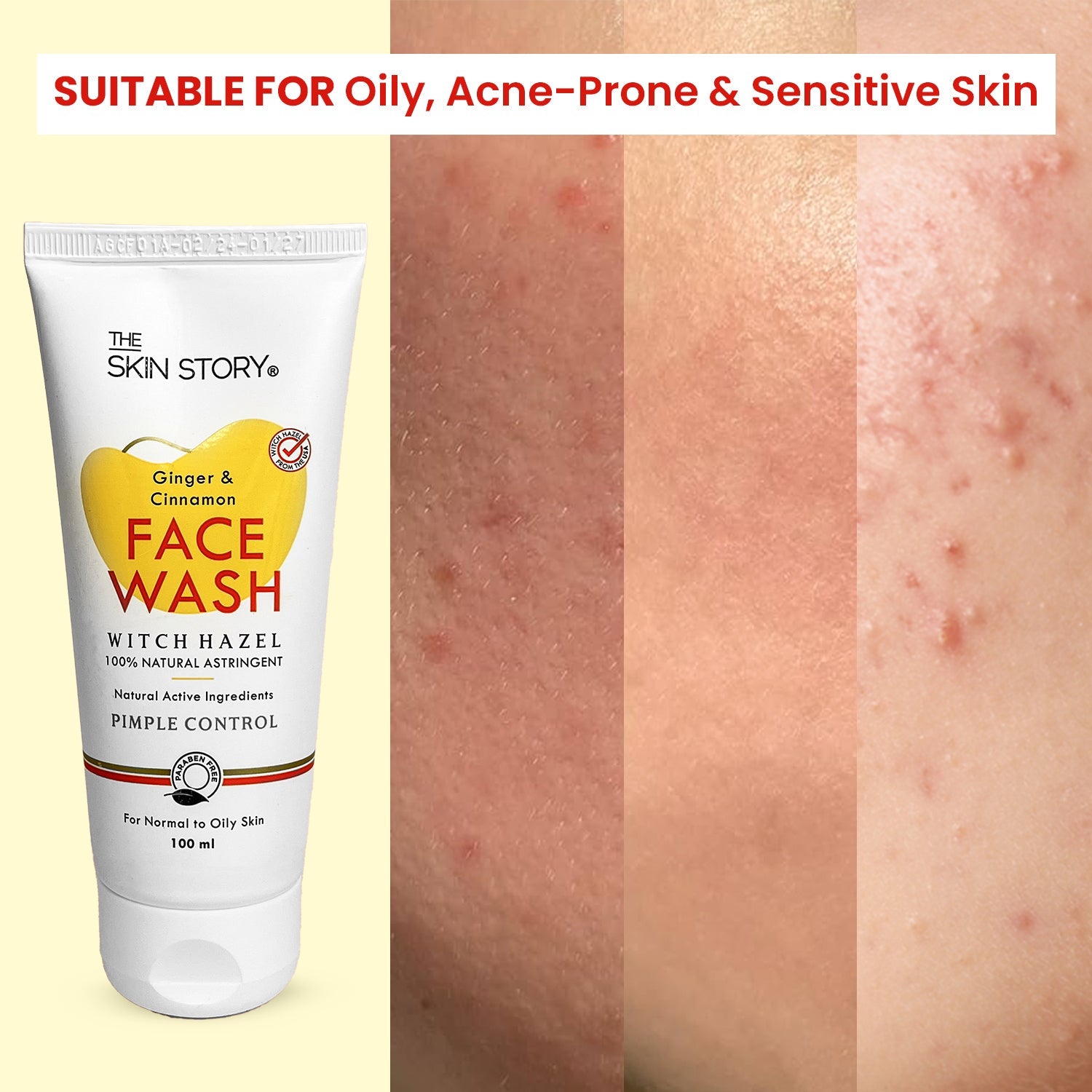 Anti - Acne & Pimple Set - The Skin Story - Face Pack