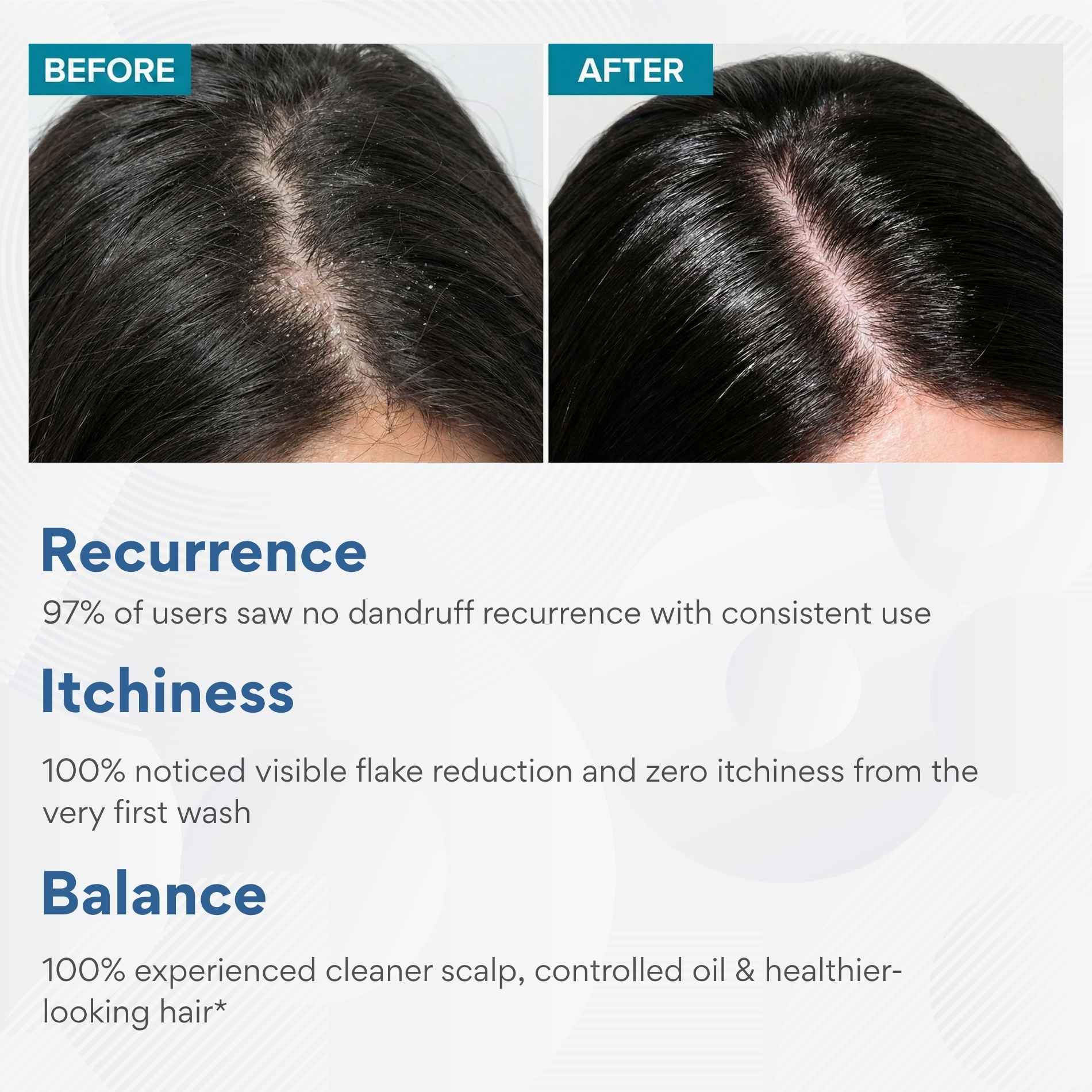 Dandruff - 3 steps - Shampoo+Exfoliating Scalp Serum+Hair Mask - The Skin Story -