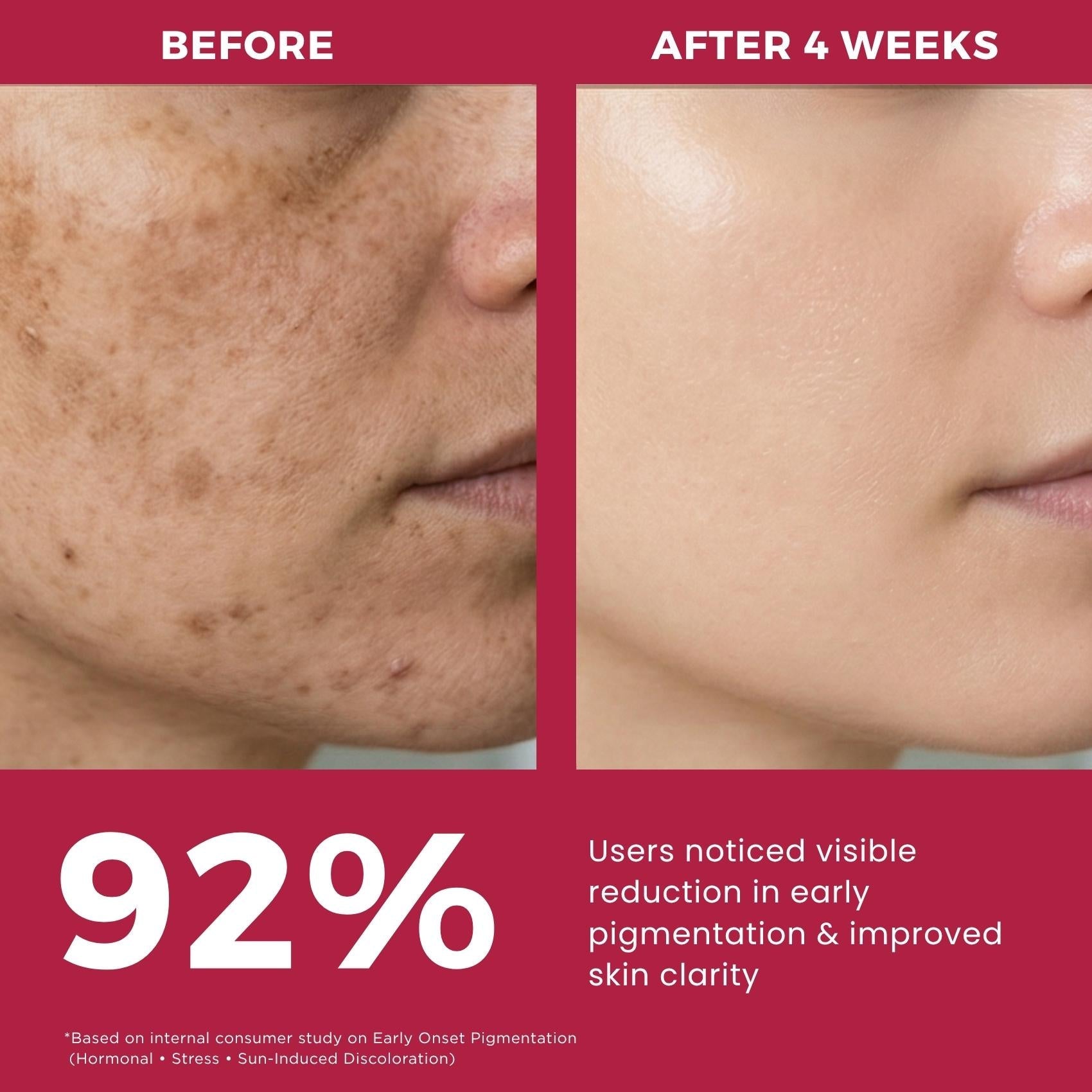 Early Onset Pigmentation 3 steps - Facewash+Corrector Serum+Sunscreen SPF50 - The Skin Story -