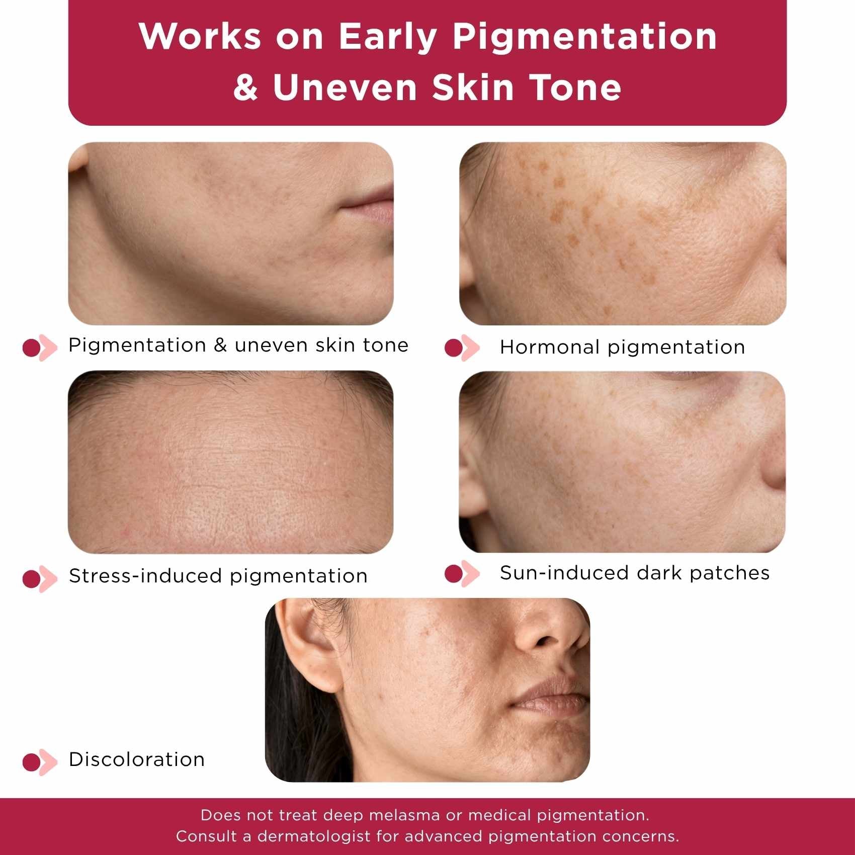 Early Onset Pigmentation 3 steps - Facewash+Corrector Serum+Sunscreen SPF50 - The Skin Story -