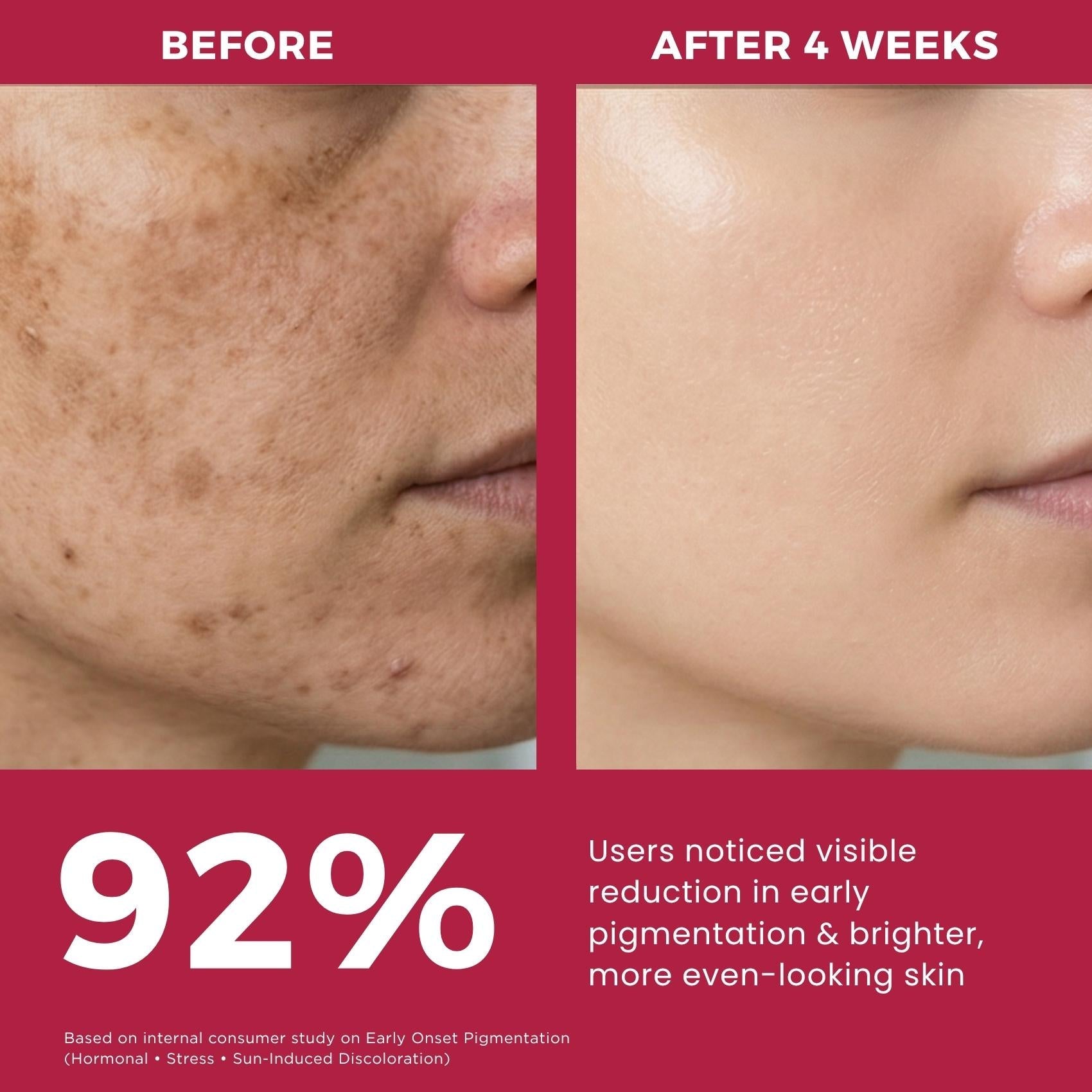 Early Onset Pigmentation 4 steps - Facewash+Corrector Serum+10% Vitamin Serum+Sunscreen SPF50 - The Skin Story -