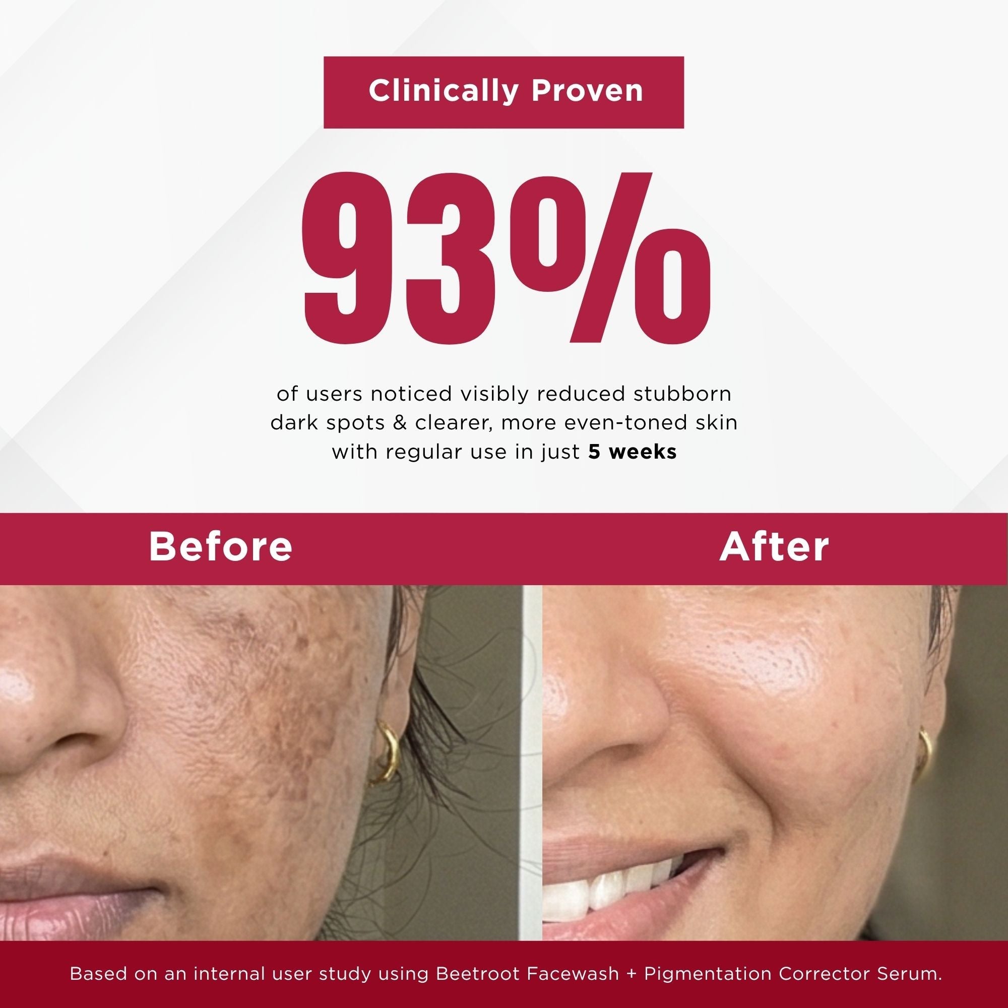 Stuborn Dark Spots 4 Steps - Facewash+Serum+ Moisturising Cream+Sunscreen SPF50 - The Skin Story -