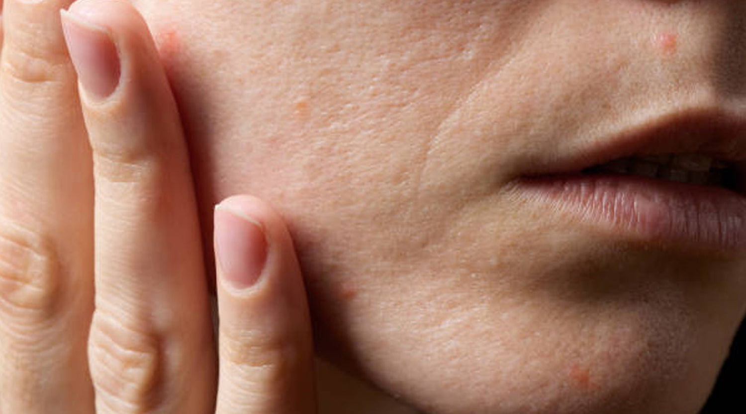 4 Proven Ways to Quickly Get Rid of Pimples - The Skin Story
