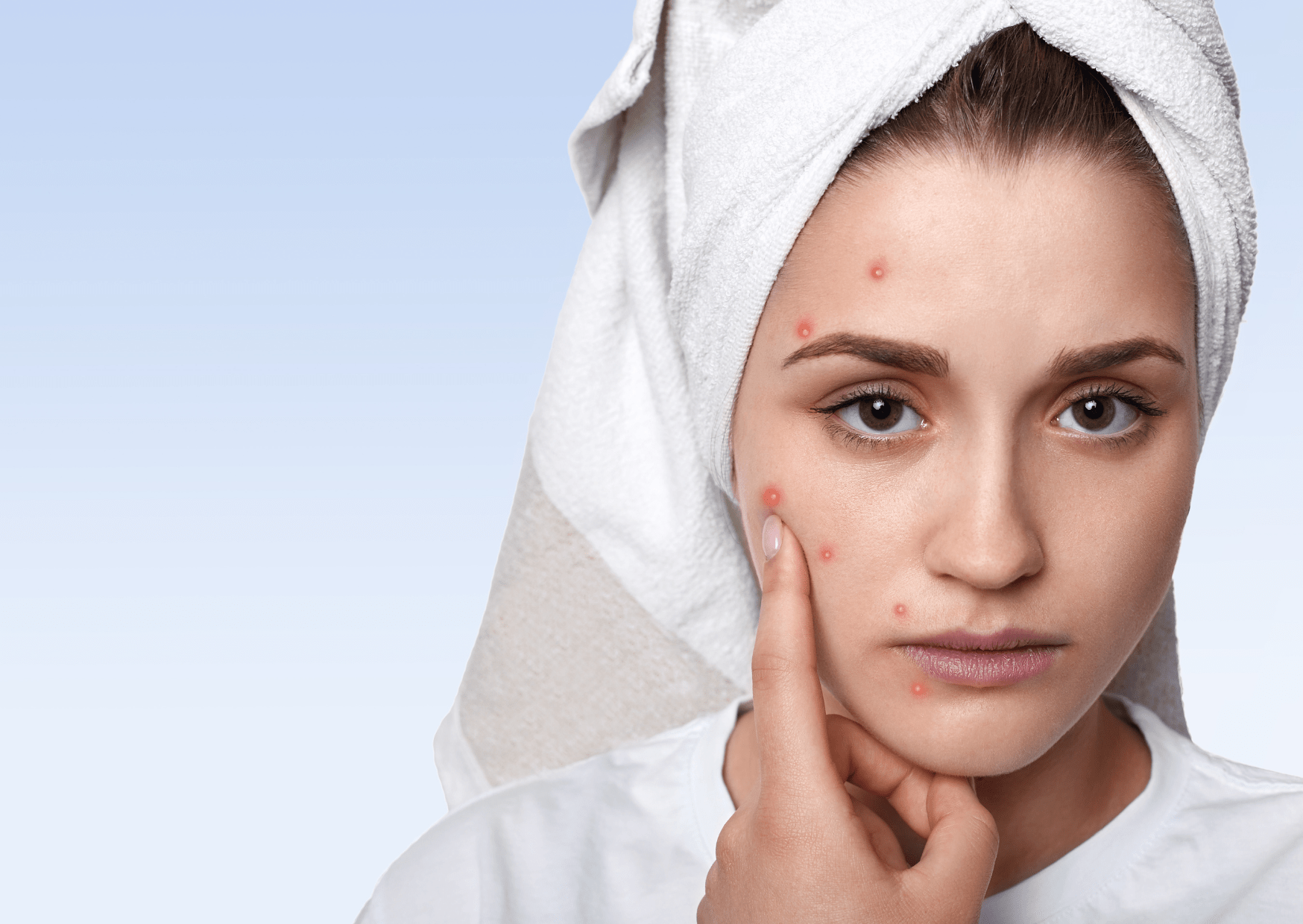 Hormonal Acne: How to Tackle Breakouts at Every Age - The Skin Story