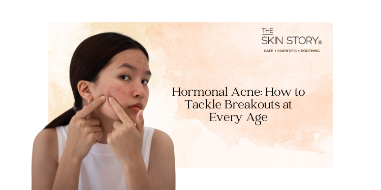 Hormonal Acne: How to Tackle Breakouts at Every Age