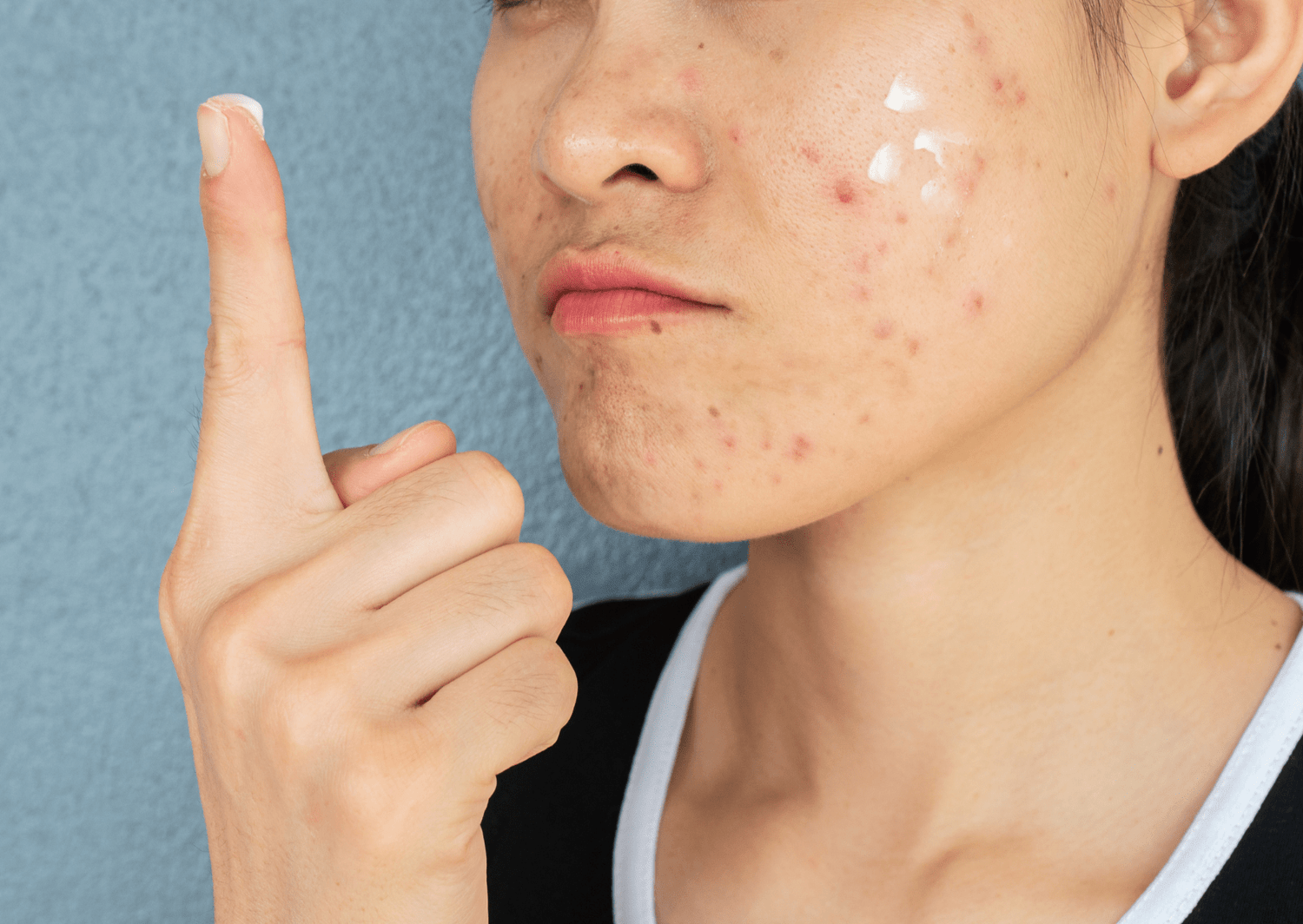 How to Treat Common Skin Issues: Acne, Rosacea, and Hyperpigmentation - The Skin Story