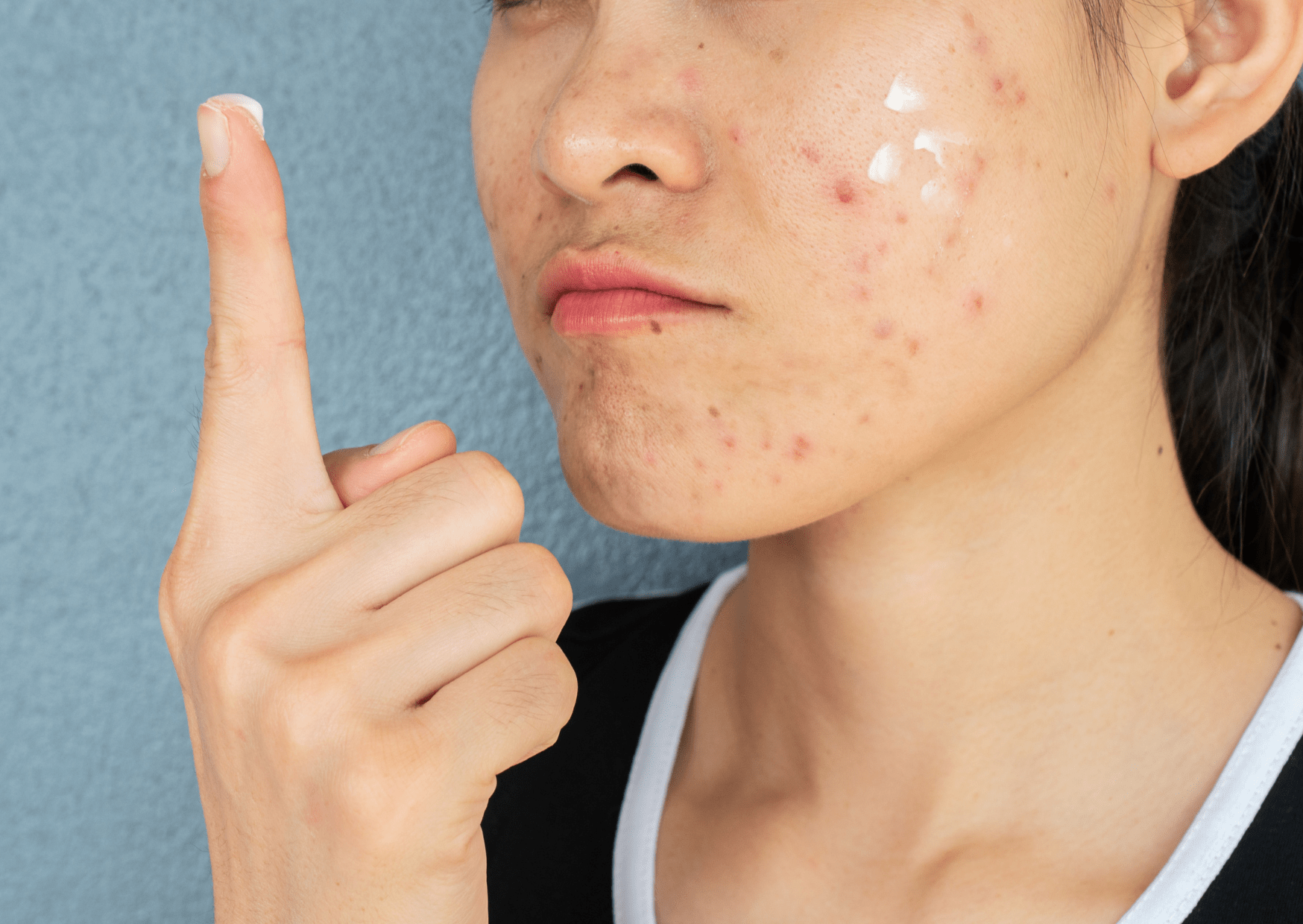 How to Treat Common Skin Issues: Acne, Rosacea, and Hyperpigmentation - The Skin Story