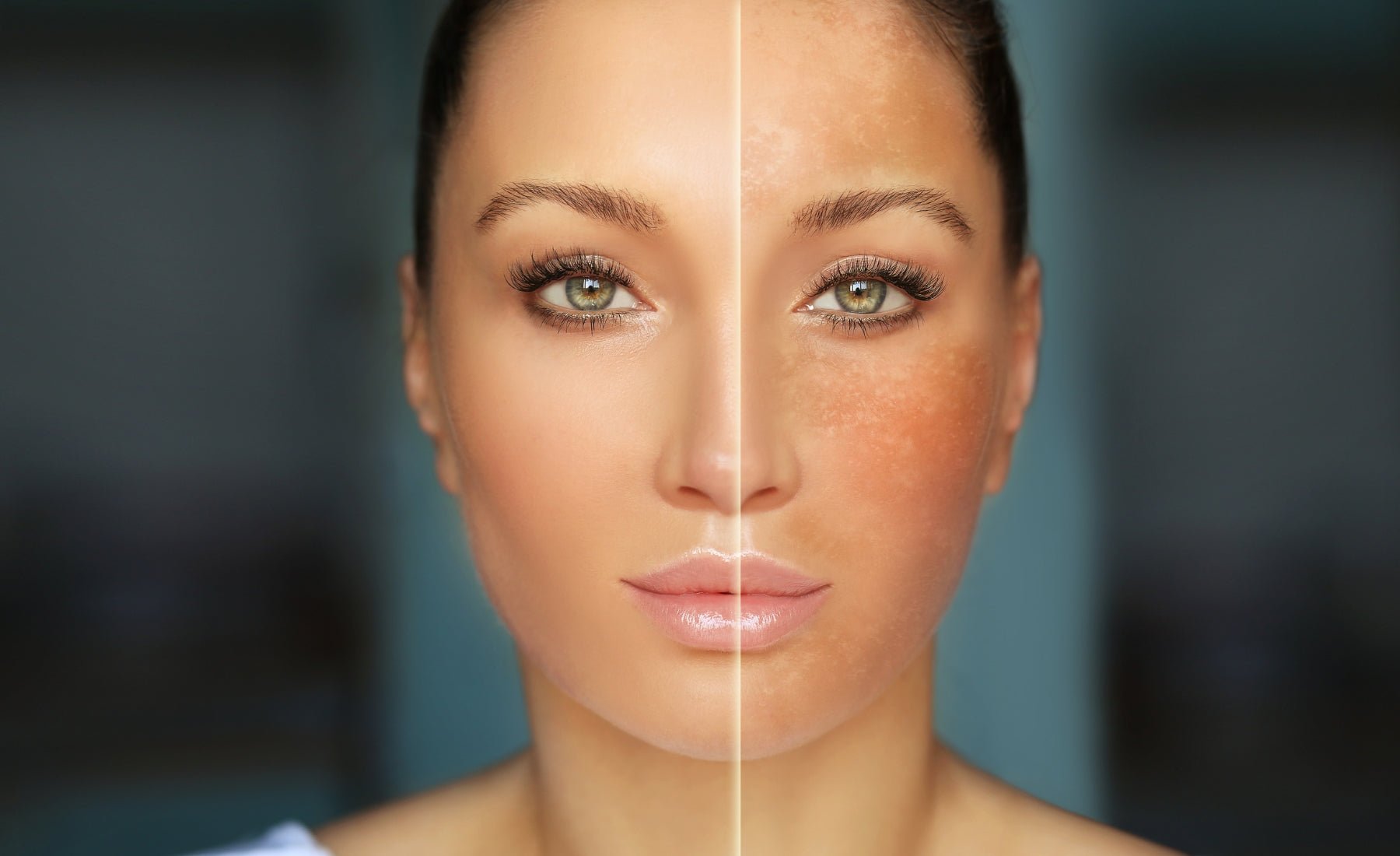 Hyperpigmentation Causes And How To Deal With It - The Skin Story