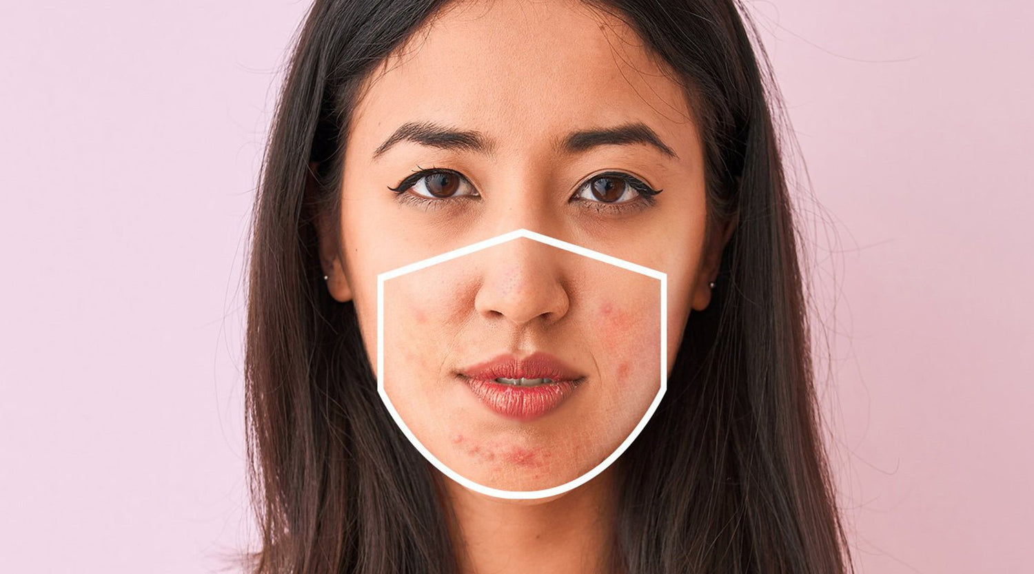 The Skin Story Talks About 3 Ways To Protect Your Face From Maskne - The Skin Story