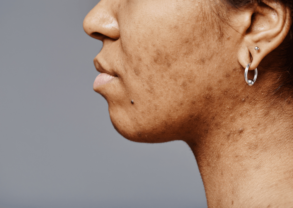 Understanding and Addressing Skin Pigmentation - The Skin Story