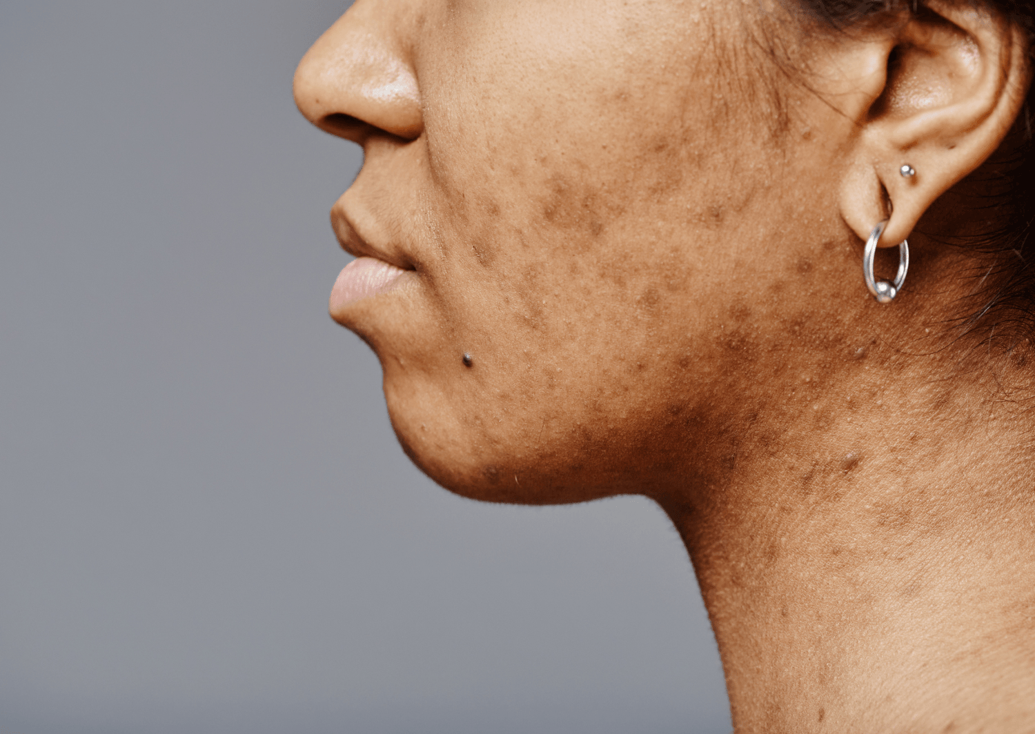 Understanding and Addressing Skin Pigmentation - The Skin Story