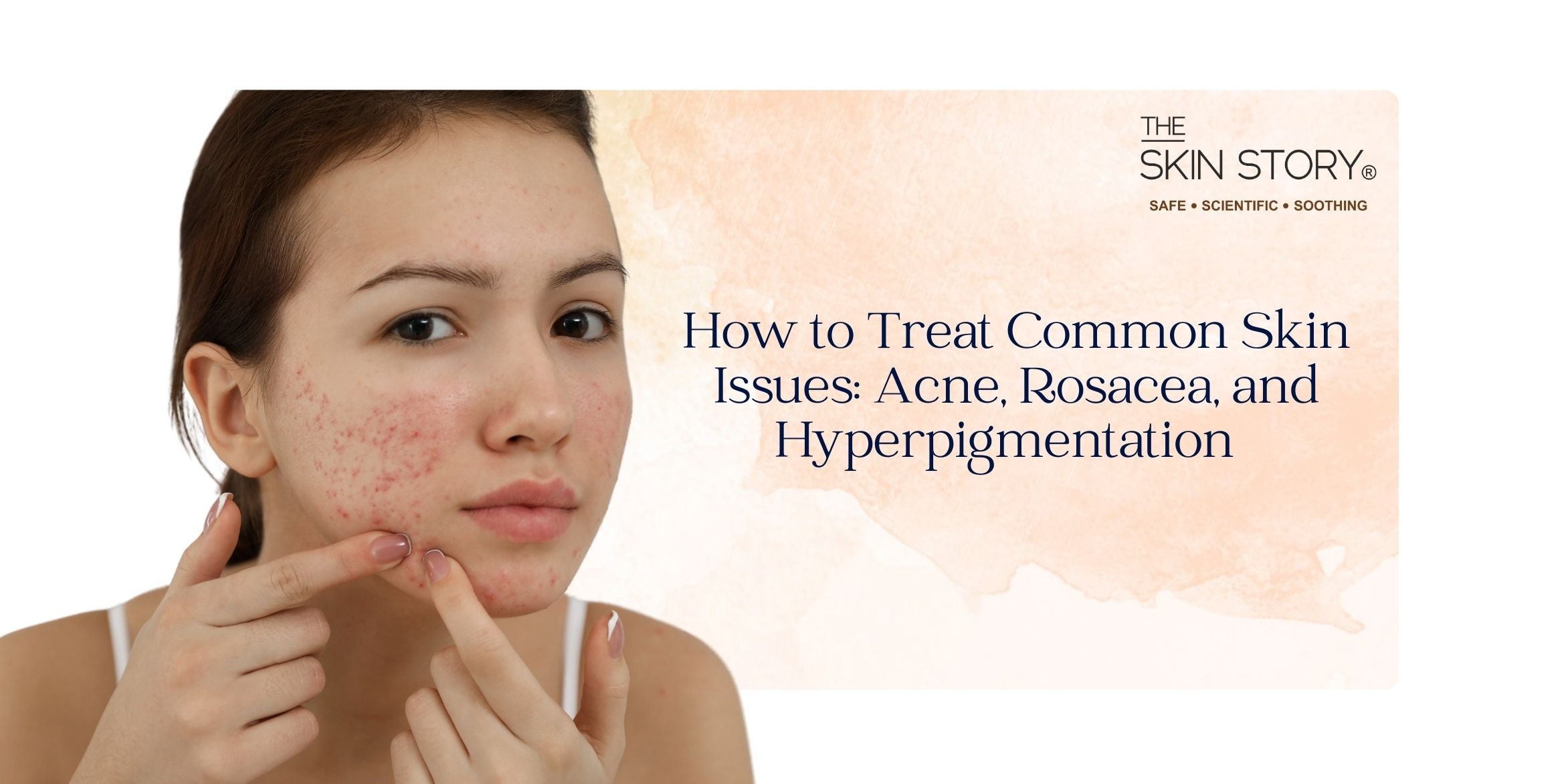 How to Treat Common Skin Issues: Acne, Rosacea, and Hyperpigmentation