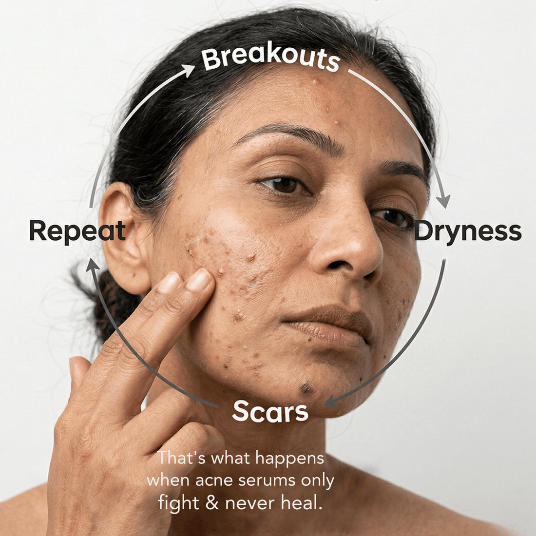 2 Step Acne Clear Regime with Facewash &amp; Serum - The Skin Story - Facewash
