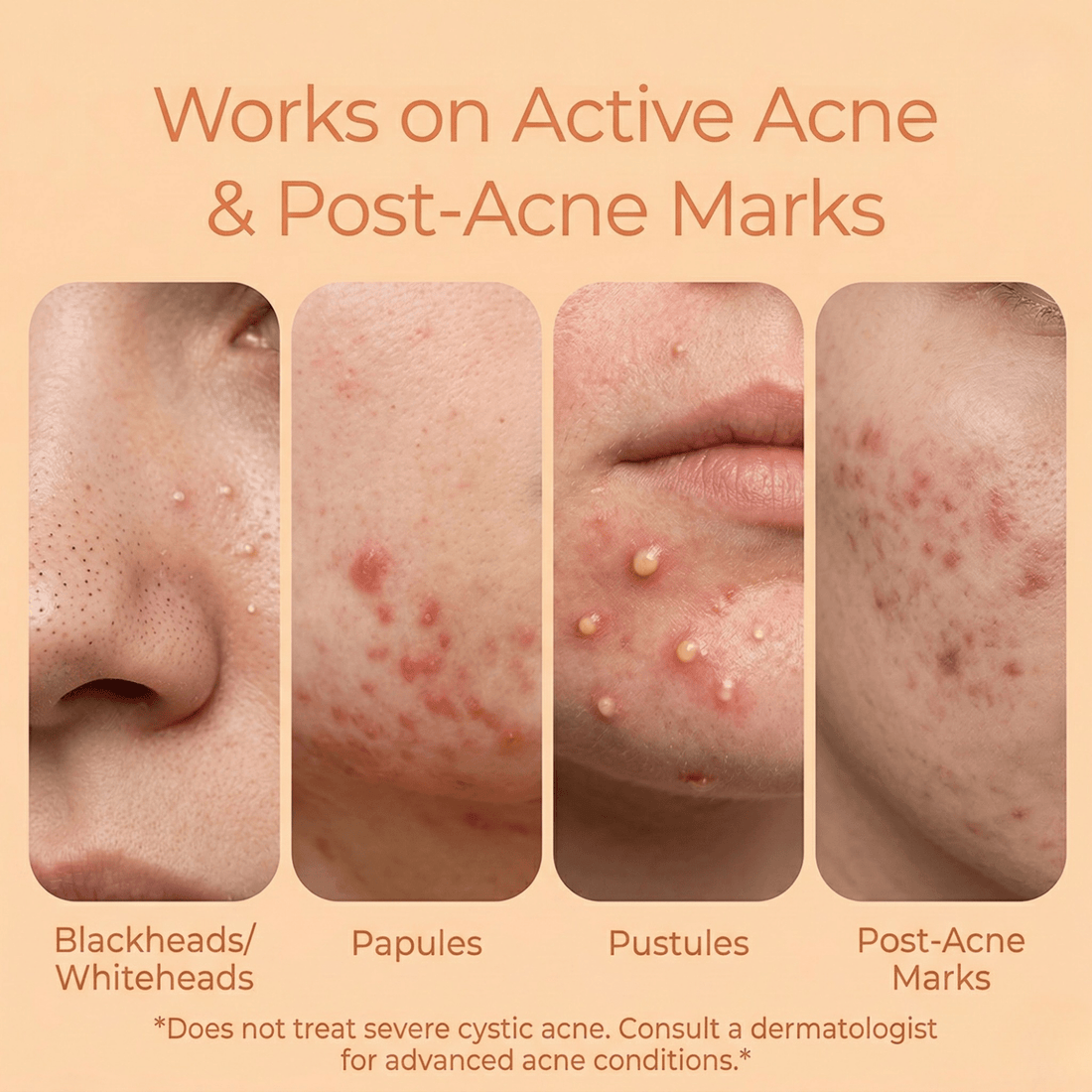 2 Step Acne Clear Regime with Facewash &amp; Serum - The Skin Story - Facewash