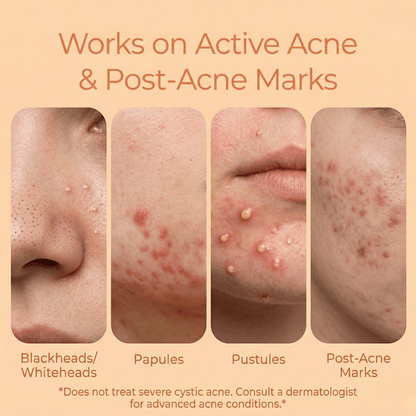 2 Step Acne Clear Regime with Facewash &amp; Serum - The Skin Story - Facewash