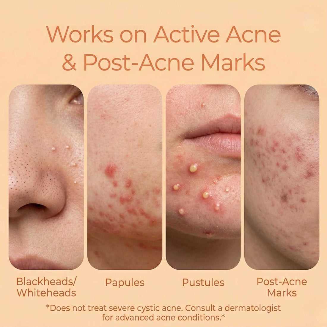2 Step Active Acne + Marks Regime with Serums - The Skin Story - 