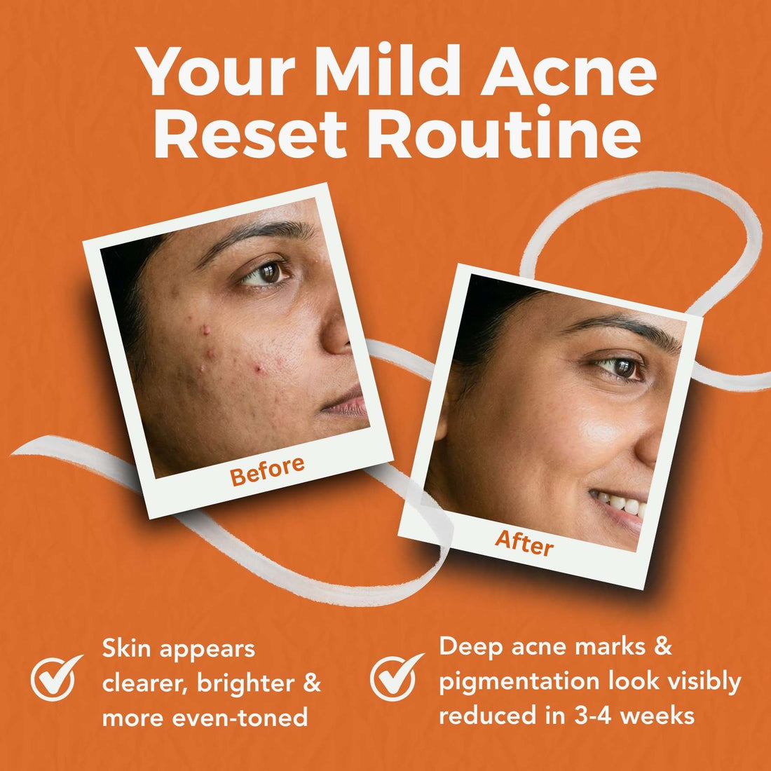 2 Steps Deep Acne Mark Regime with Serums - The Skin Story - 