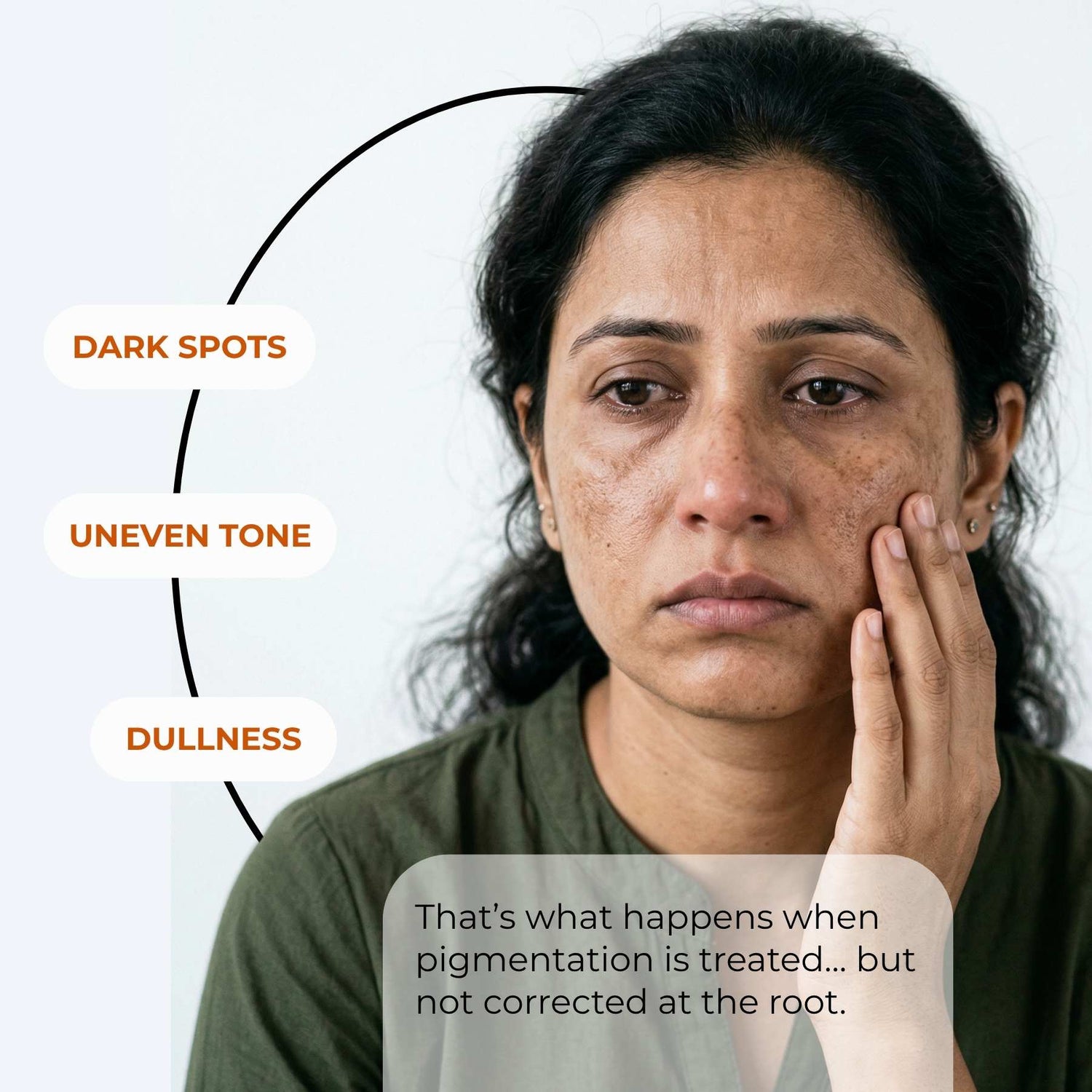2 Steps Deep Acne Mark Regime with Serums - The Skin Story - 