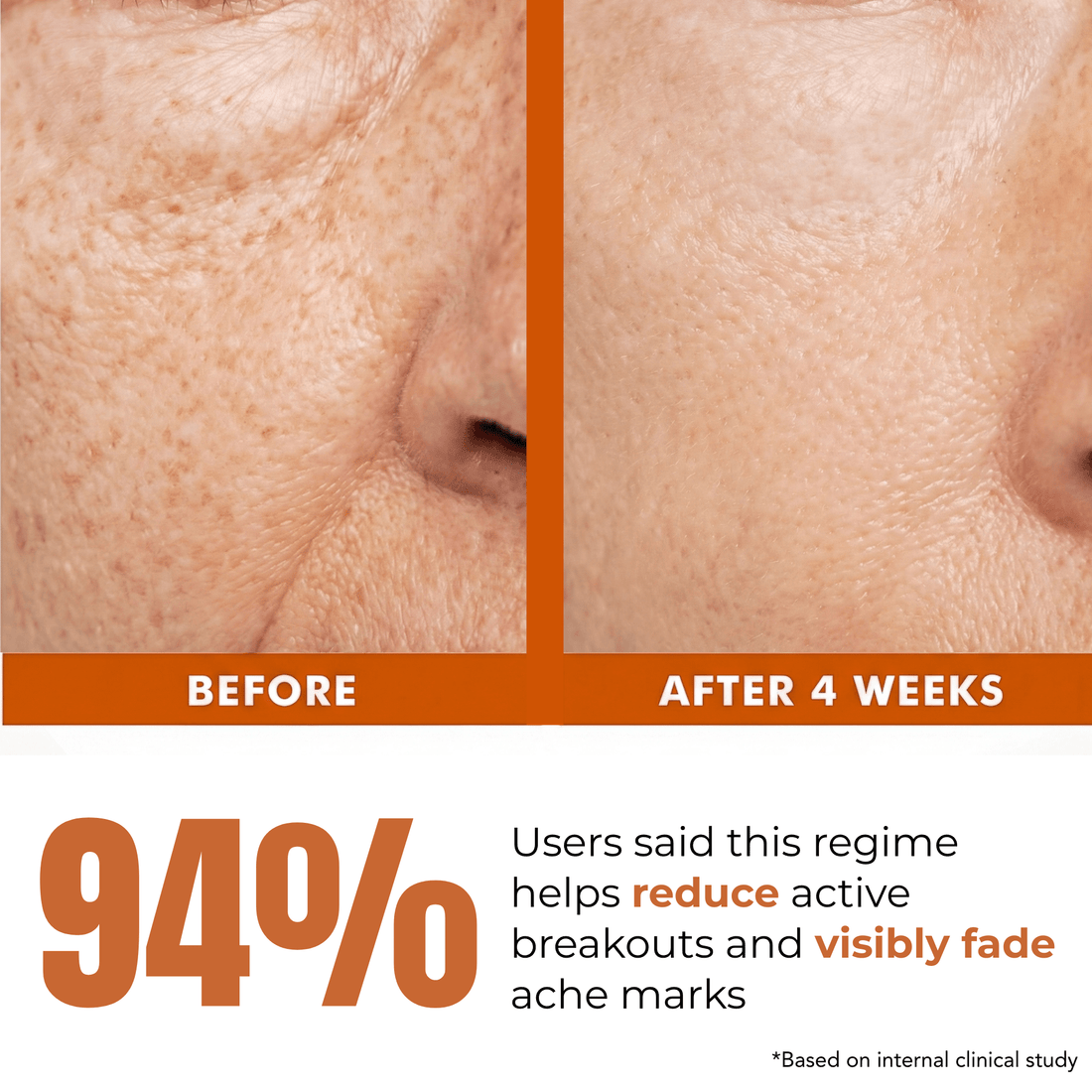 4 Step Acne + Marks Clear Regime with Facewash, Serums &amp; Sunscreen SPF50 - The Skin Story - 