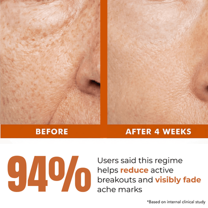 4 Step Acne + Marks Clear Regime with Facewash, Serums &amp; Sunscreen SPF50 - The Skin Story - 