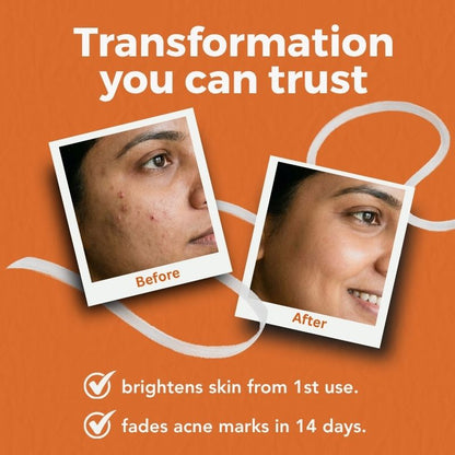 The Skin Story Acne Clearing Serum, 25ml