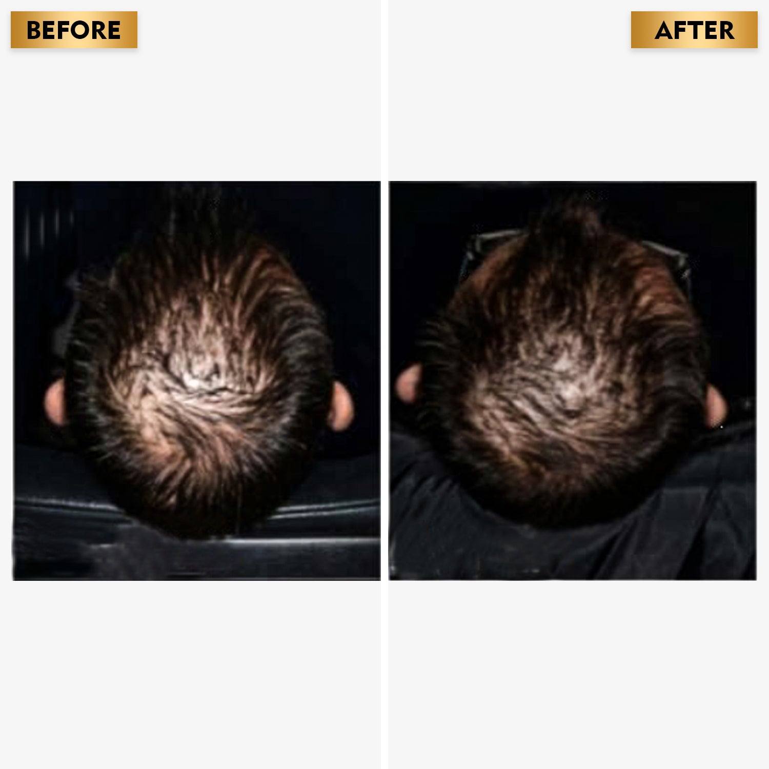 Hair Growth Serum with 3% Redensyl®️ + 4% Anagain