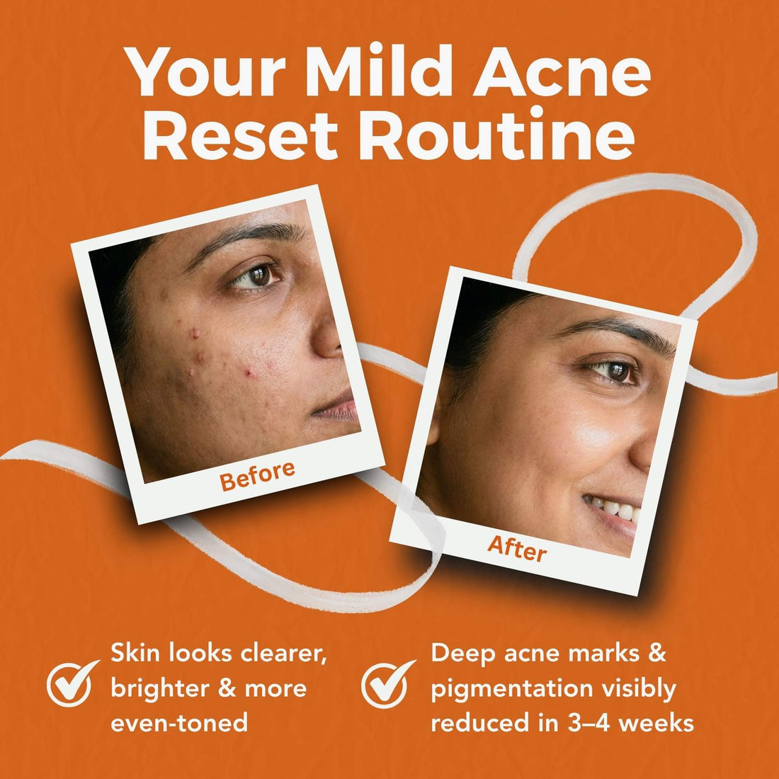 Acne Pigmentation Repair Regime – Deep Spot Correction Routine - The Skin Story - 