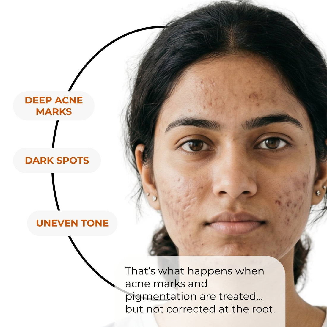 Acne Pigmentation Repair Regime – Deep Spot Correction Routine - The Skin Story - 