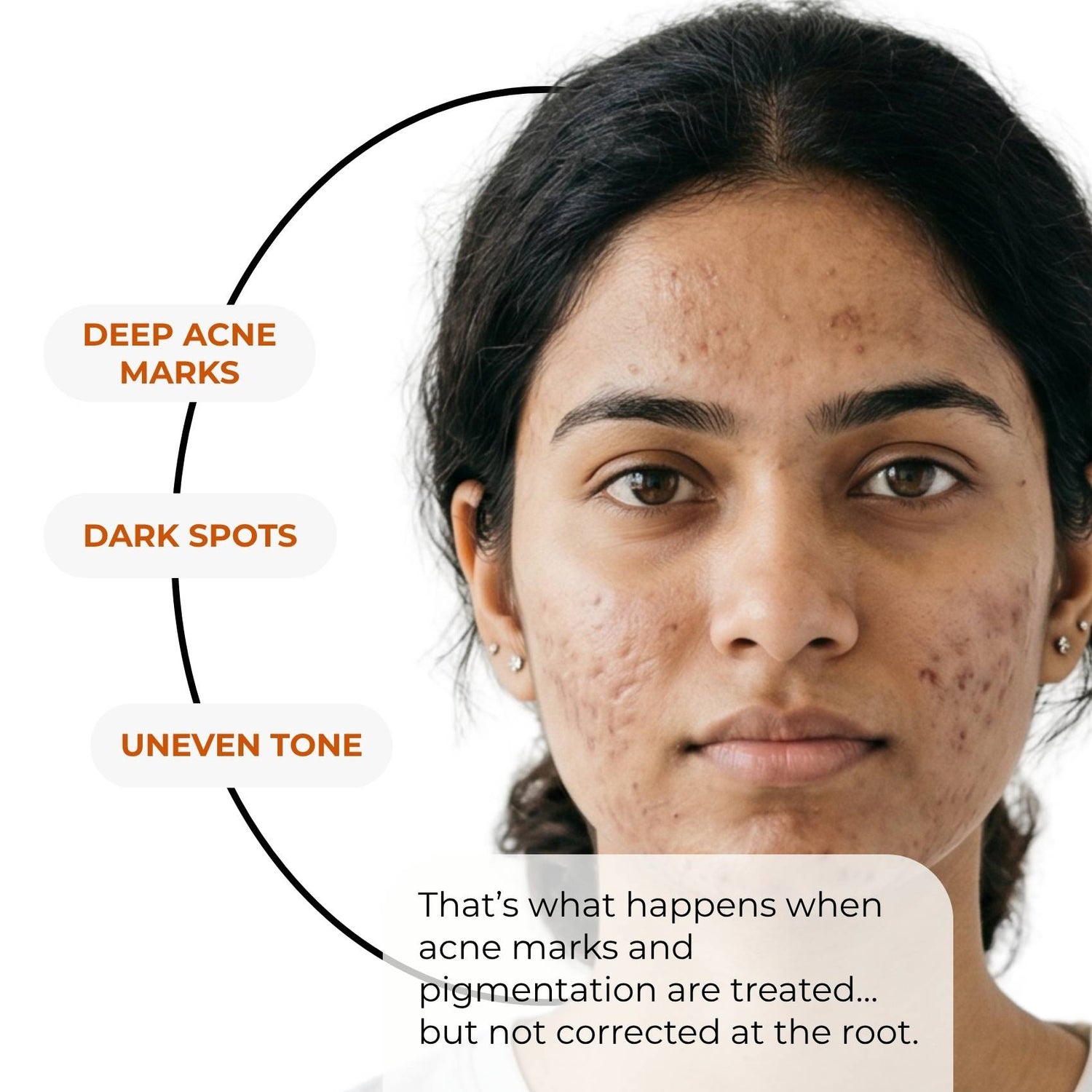 Acne Pigmentation Repair Regime – Deep Spot Correction Routine - The Skin Story - 
