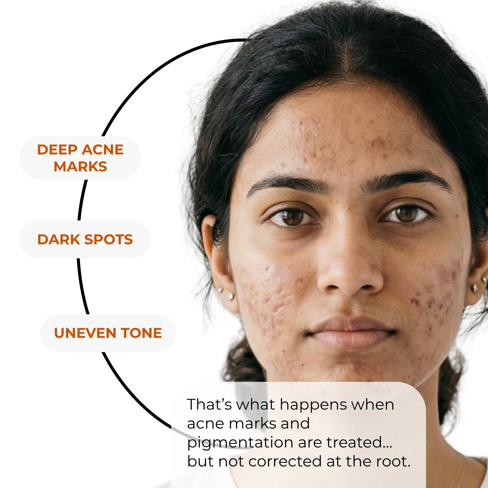 Acne Pigmentation Repair Regime – Deep Spot Correction Routine - The Skin Story - 
