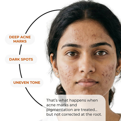 Acne Pigmentation Repair Regime – Deep Spot Correction Routine - The Skin Story - 