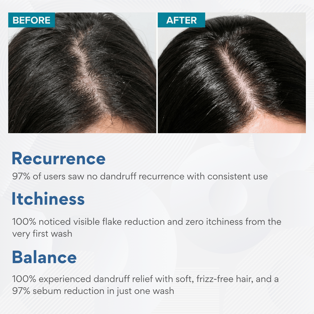 Anti - Dandruff Shampoo - The Skin Story - shampoo