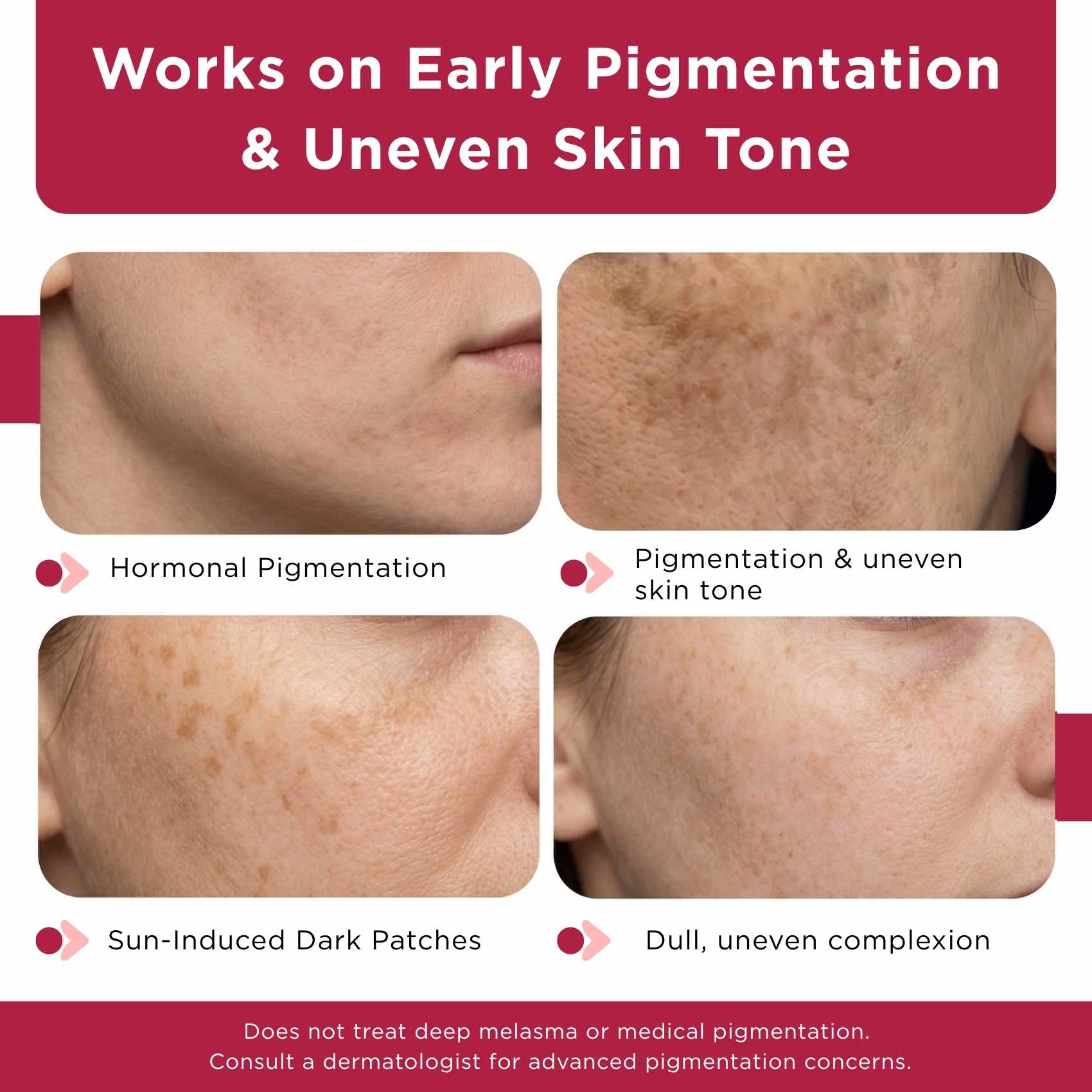 Early Onset Pigmentation 4 steps - Facewash+Corrector Serum+10% Vitamin Serum+Sunscreen SPF50 - The Skin Story - 