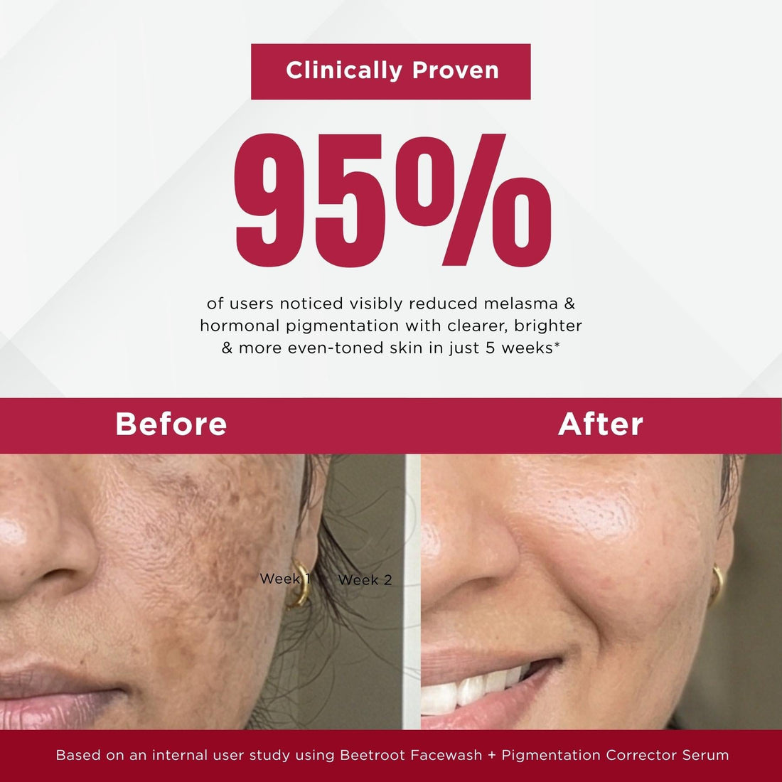 Melesma 4 Steps - Facewash+Serums+Moisturising Cream+Sunscreen SPF50 - The Skin Story - 
