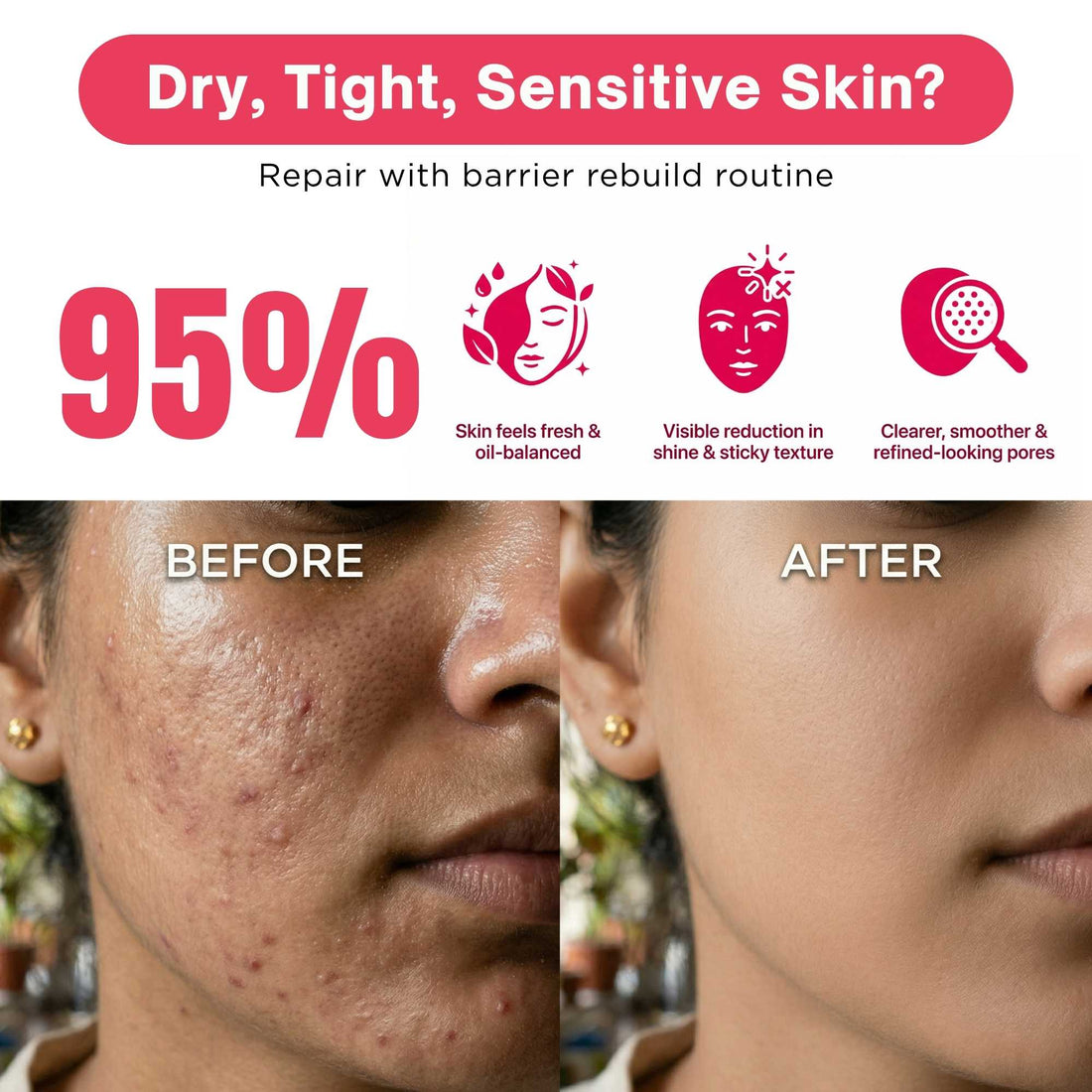 Oil Control 2 Steps - Facewash+Oil Free Moisturiser - The Skin Story - 