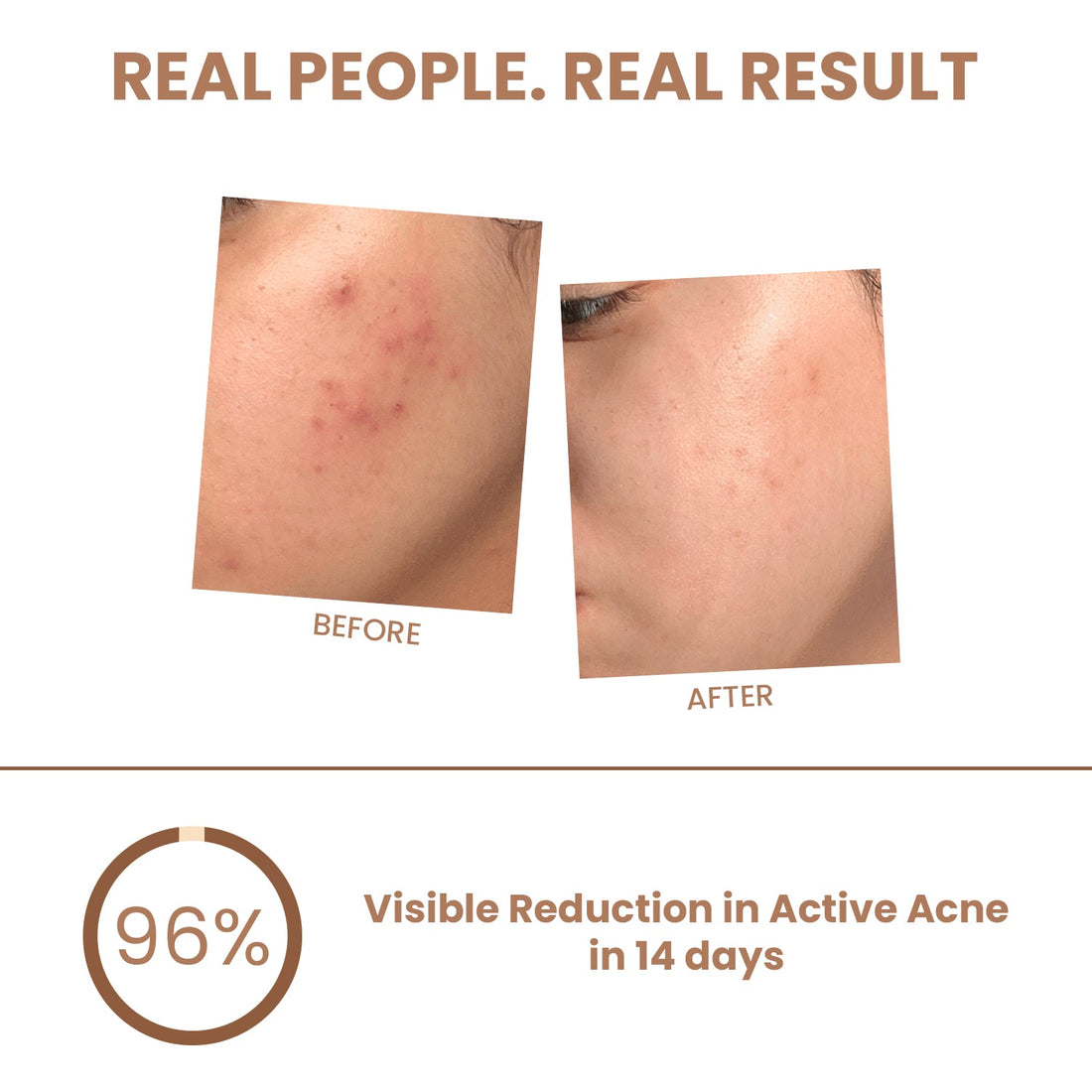Pimple &amp; Acne Corrector Gel - The Skin Story - 