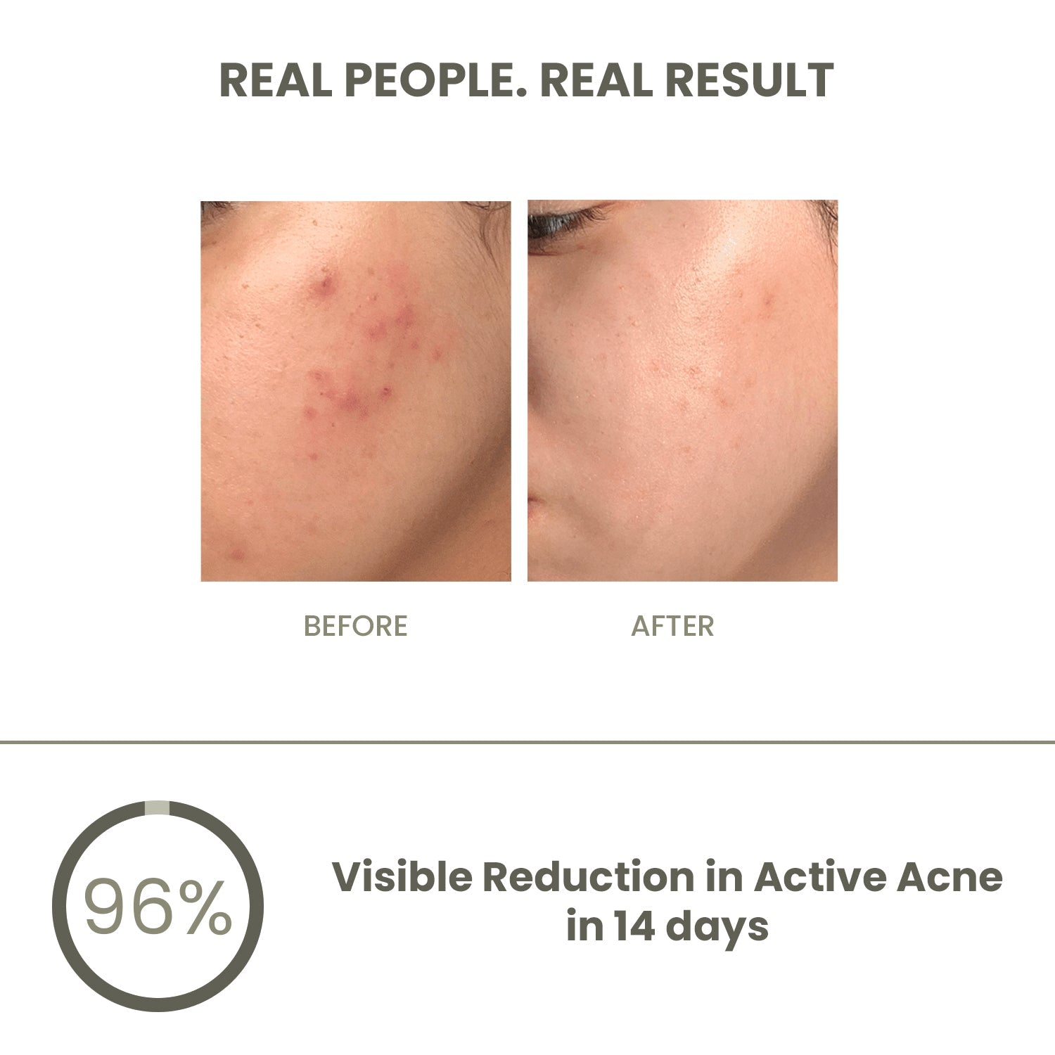 Pimple Control Combo Clear Glowing Skin - The Skin Story - 