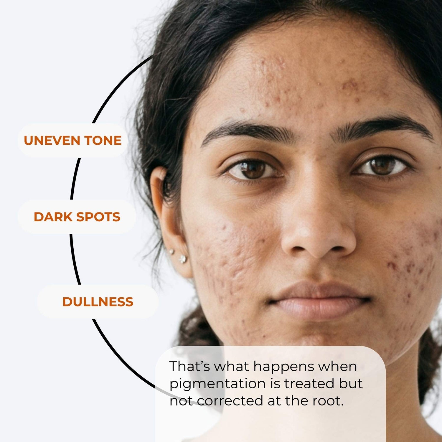 Pimple Spot Repair Regime – Acne Marks Treatment Routine - The Skin Story - 