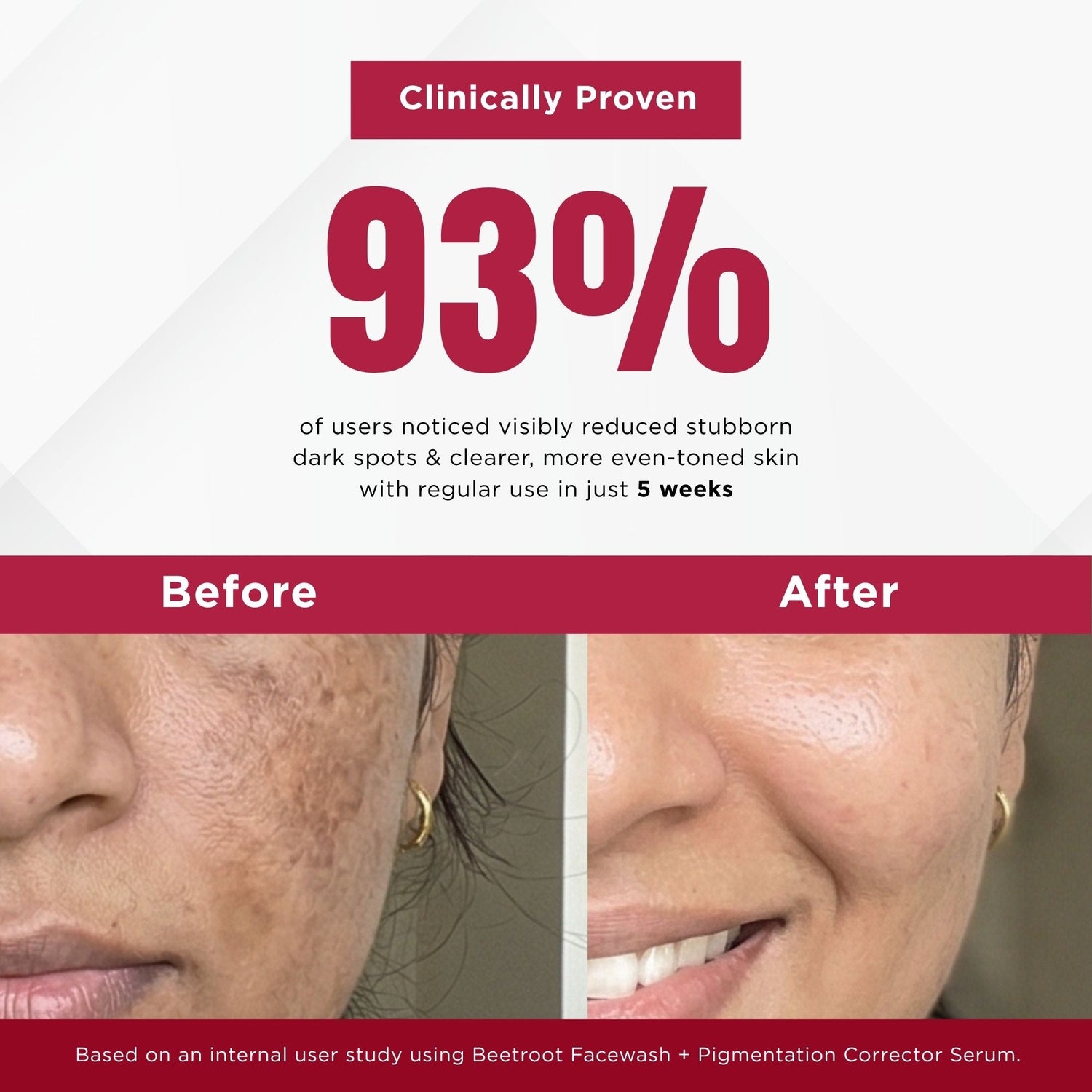 Stuborn Dark Spots 4 Steps - Facewash+Serum+ Moisturising Cream+Sunscreen SPF50 - The Skin Story - 