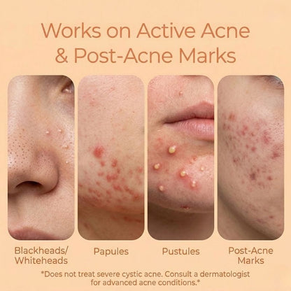 The Skin Story Acne Clearing Serum, 25ml - The Skin Story - 